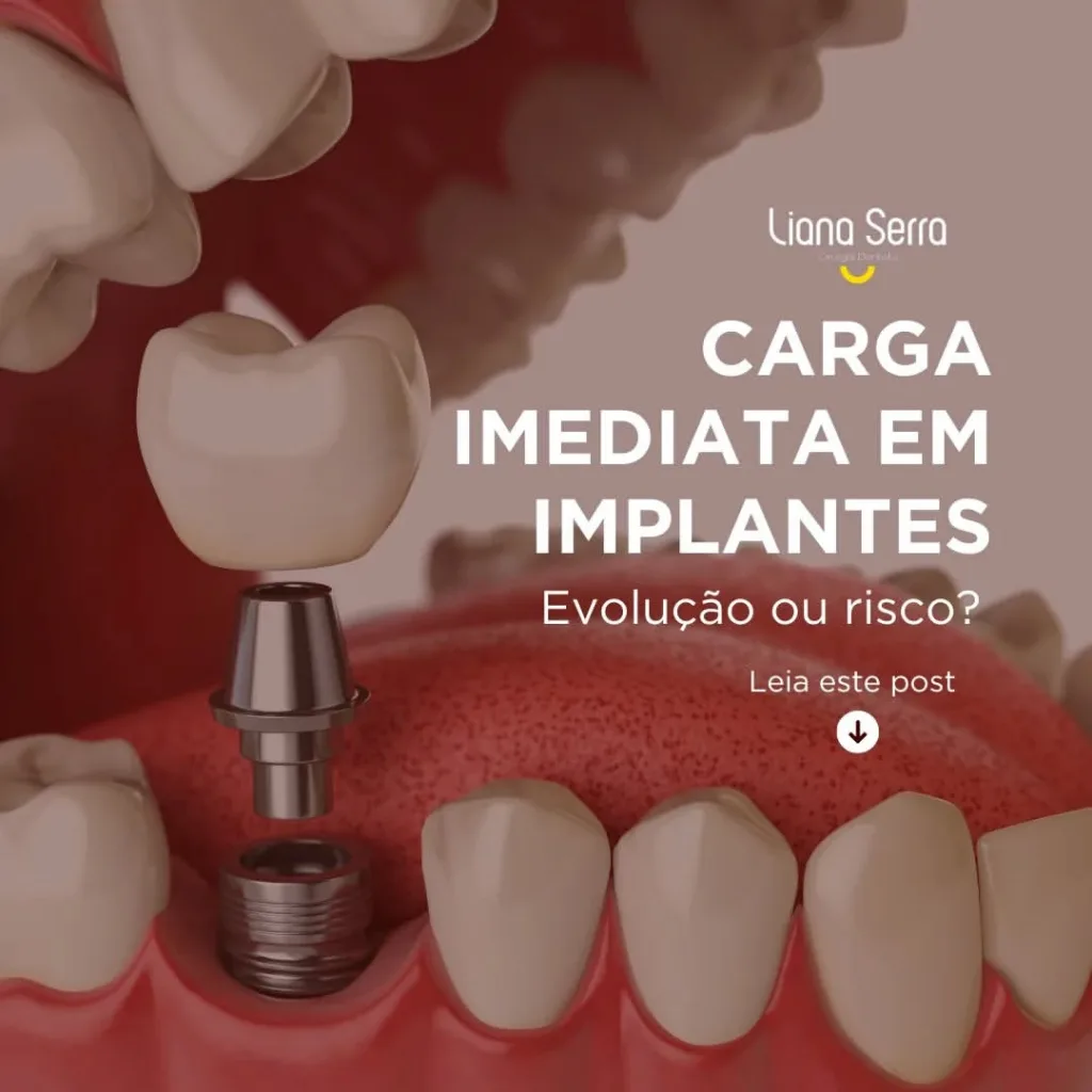 Carga imediata Implante