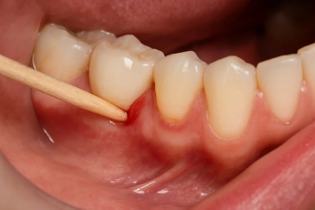 Palito de Dente Causa Retração Gengival? Descubra o Perigo Oculto que Poucos Sabem