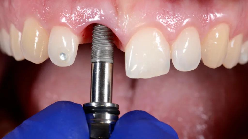 Implante dentário